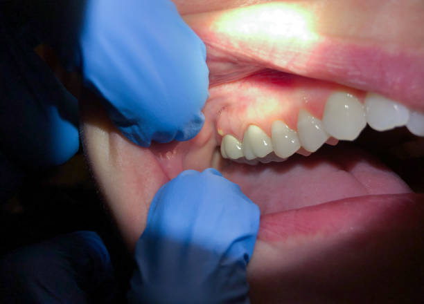 Best Emergency Dentist for Lost Fillings or Crowns in Parachute, CO