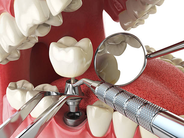 Best Broken or Cracked Tooth Emergency Dentist in Parachute, CO